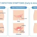 what does a yeast infection look like